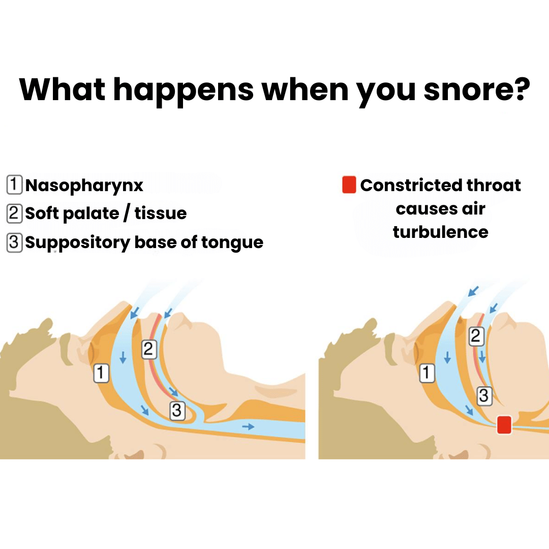 Nuraya Anti-Snoring Mouthpiece