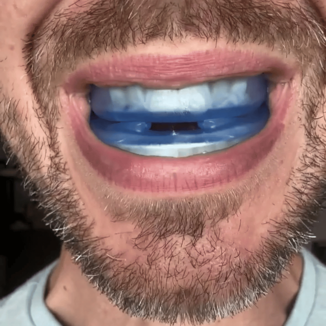 Nuraya Anti-Snoring Mouthpiece